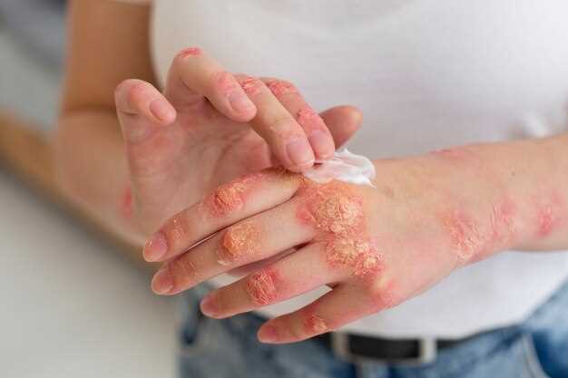 Azithromycin skin rash pictures