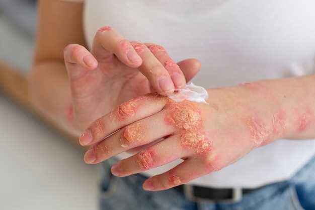 Azithromycin skin rashes