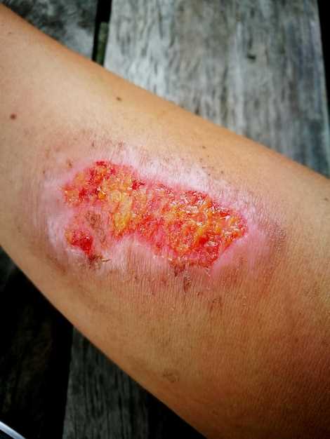 Maculopapular rash azithromycin