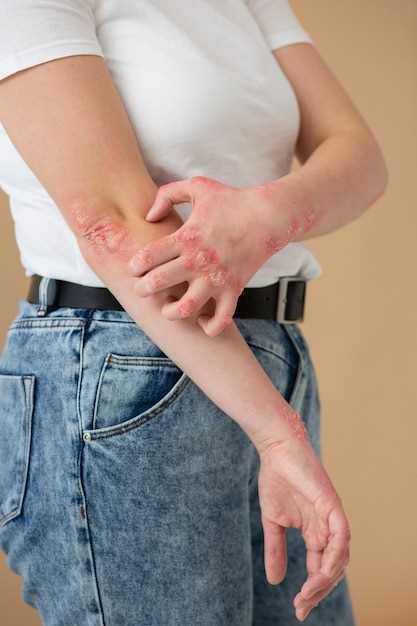 What does azithromycin rash look like